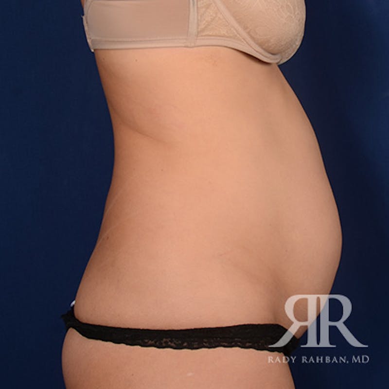 Tummy Tuck Before & After Gallery - Patient 218891 - Image 5