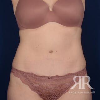 Tummy Tuck Before & After Gallery - Patient 405536 - Image 2