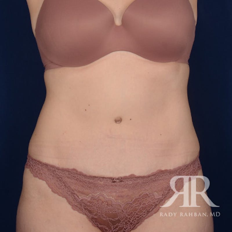 Tummy Tuck Before & After Gallery - Patient 405536 - Image 2