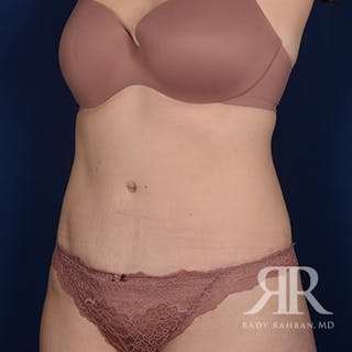 Tummy Tuck Before & After Gallery - Patient 405536 - Image 4