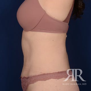 Tummy Tuck Before & After Gallery - Patient 405536 - Image 6