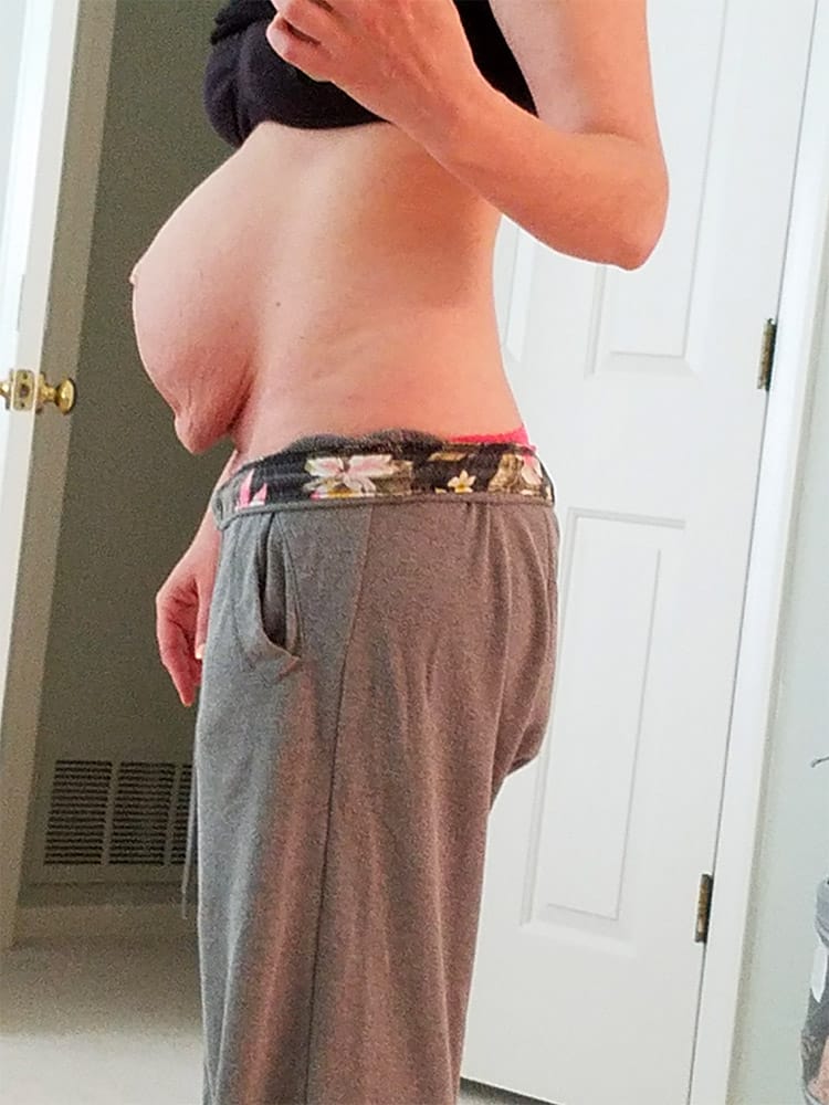 Diastasis Recti patient