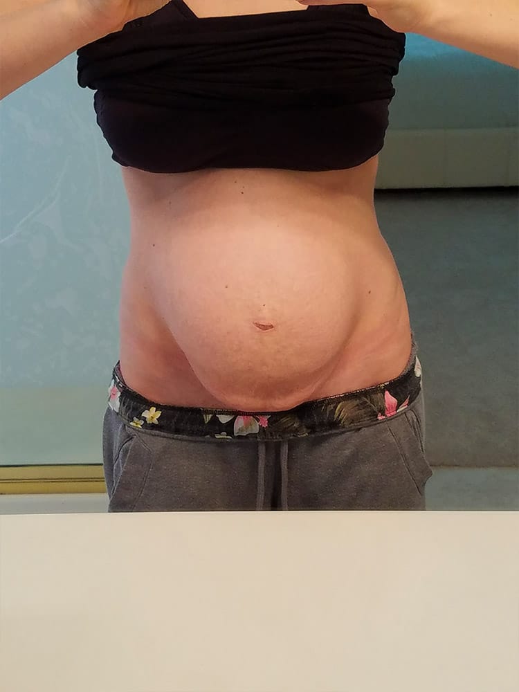 Diastasis Recti patient