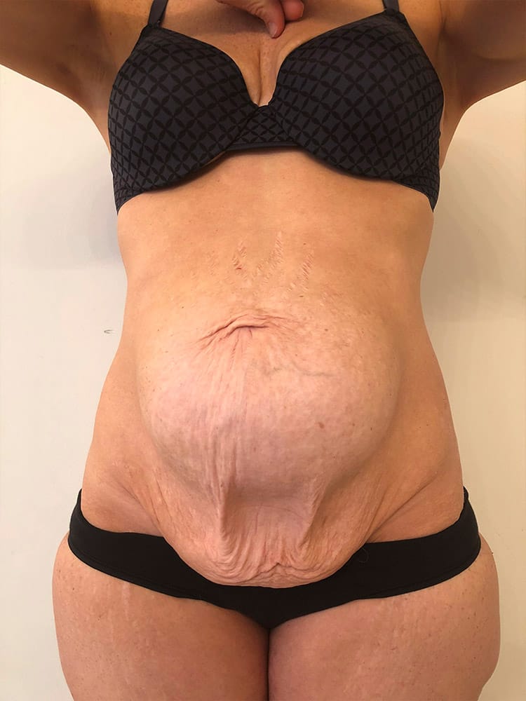 Diastasis Recti patient