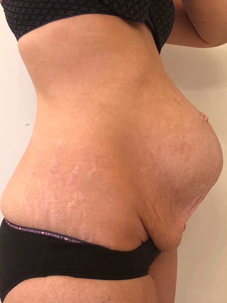 Diastasis Recti patient