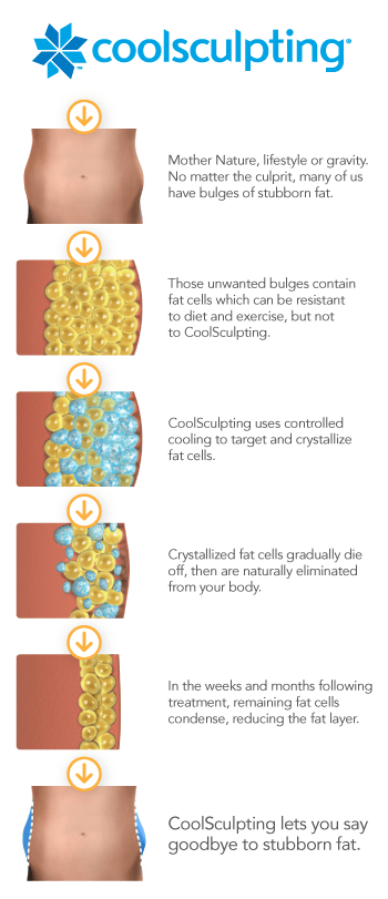 CoolSculpting infographic