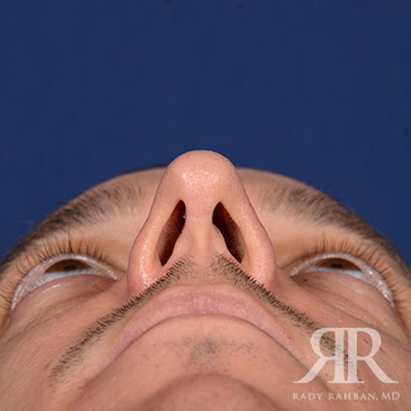 Male Rhinoplasty Before & After Gallery - Patient 152381 - Image 7