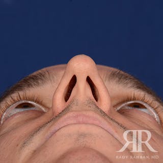 Male Rhinoplasty Before & After Gallery - Patient 152381 - Image 8