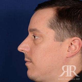 Male Rhinoplasty Before & After Gallery - Patient 152381 - Image 6