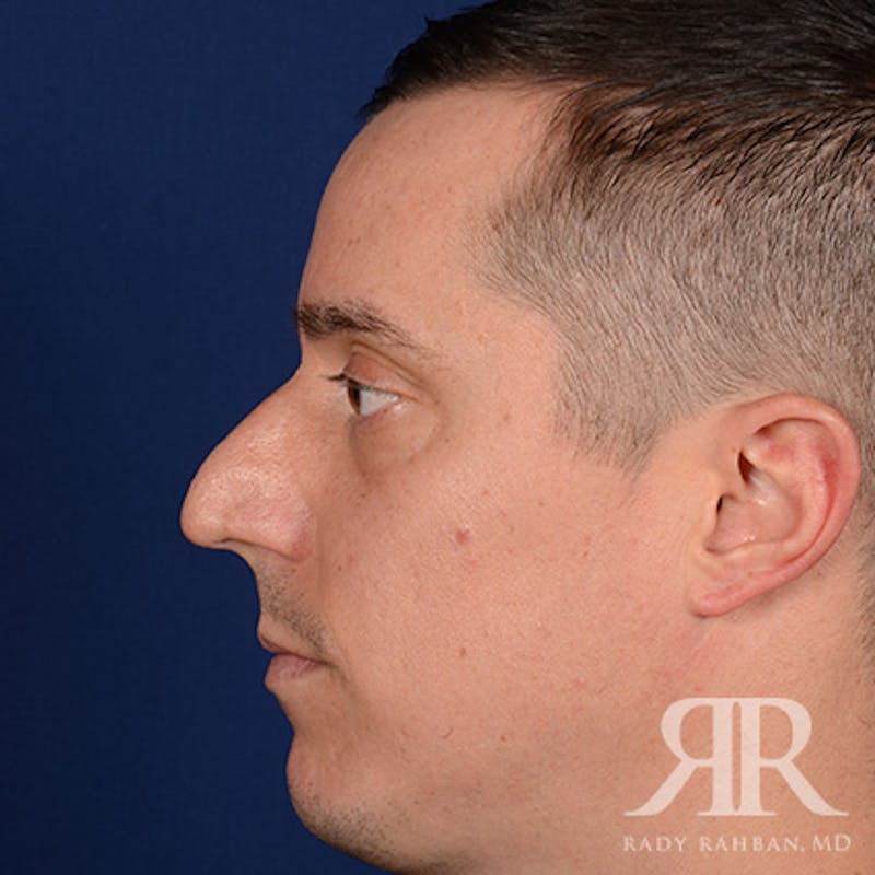 Male Rhinoplasty Before & After Gallery - Patient 152381 - Image 5