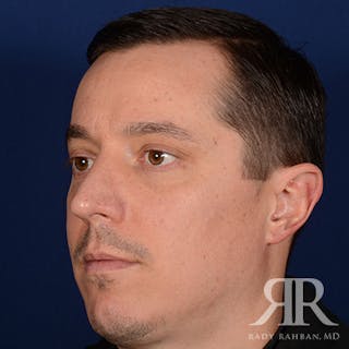 Male Rhinoplasty Before & After Gallery - Patient 152381 - Image 4