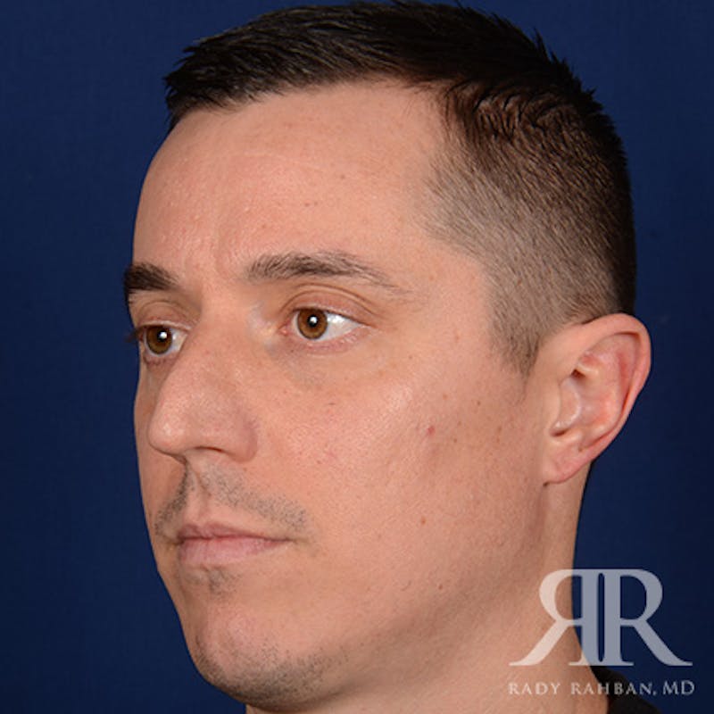 Male Rhinoplasty Before & After Gallery - Patient 152381 - Image 3