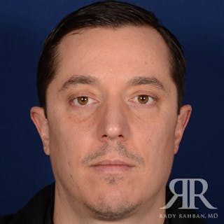 Male Rhinoplasty Before & After Gallery - Patient 152381 - Image 2