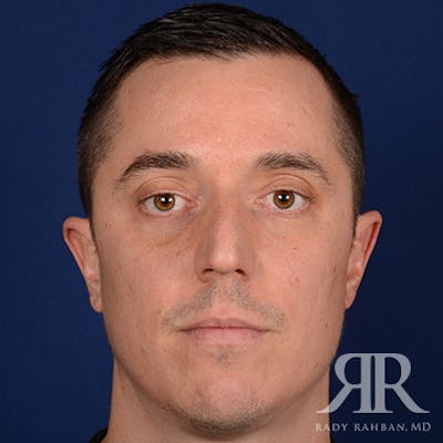 Male Rhinoplasty Before & After Gallery - Patient 152381 - Image 1