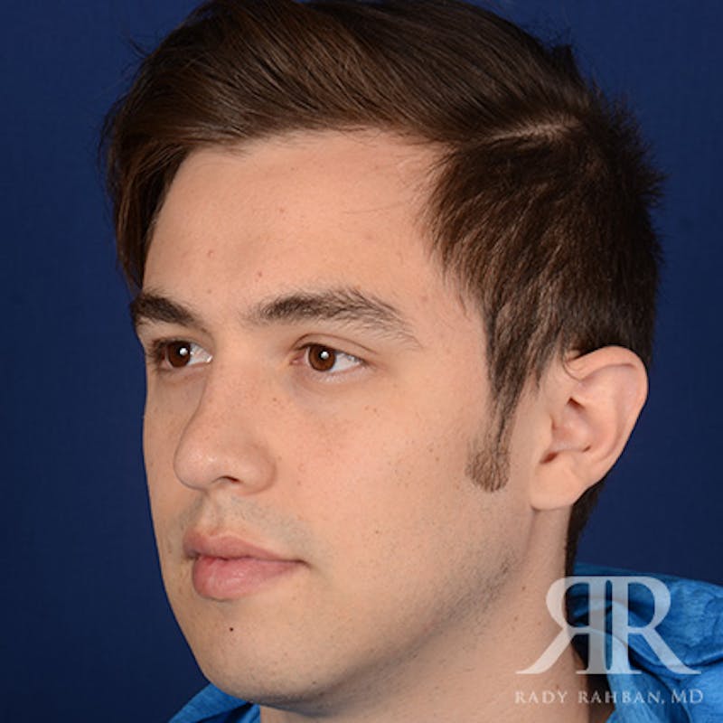 Male Rhinoplasty Before & After Gallery - Patient 173255 - Image 3