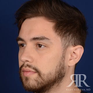 Male Rhinoplasty Before & After Gallery - Patient 173255 - Image 4