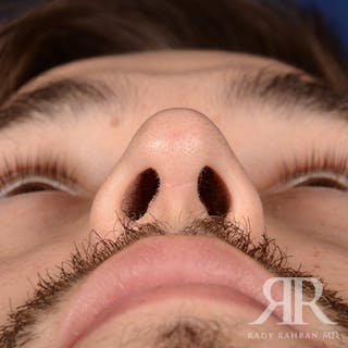 Male Rhinoplasty Before & After Gallery - Patient 173255 - Image 8