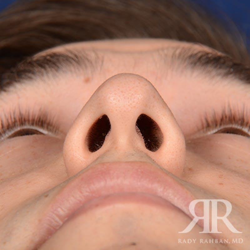Male Rhinoplasty Before & After Gallery - Patient 173255 - Image 7