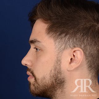 Male Rhinoplasty Before & After Gallery - Patient 173255 - Image 6