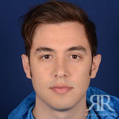 Male Rhinoplasty Before & After Gallery - Patient 173255 - Image 1
