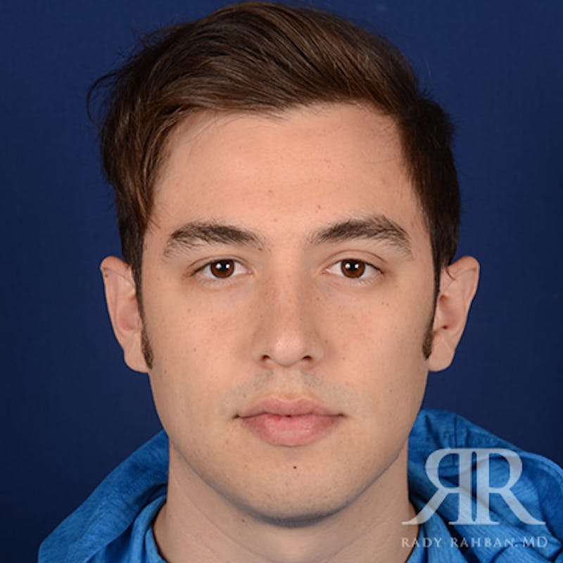 Male Rhinoplasty Before & After Gallery - Patient 173255 - Image 1