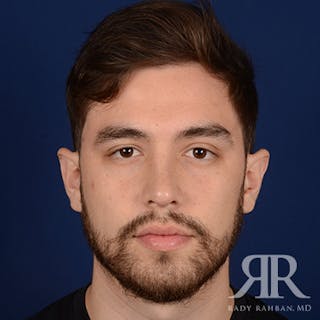 Male Rhinoplasty Before & After Gallery - Patient 173255 - Image 2