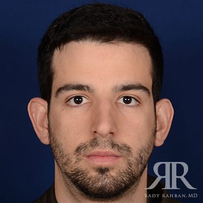 Male Rhinoplasty Before & After Gallery - Patient 360368 - Image 1