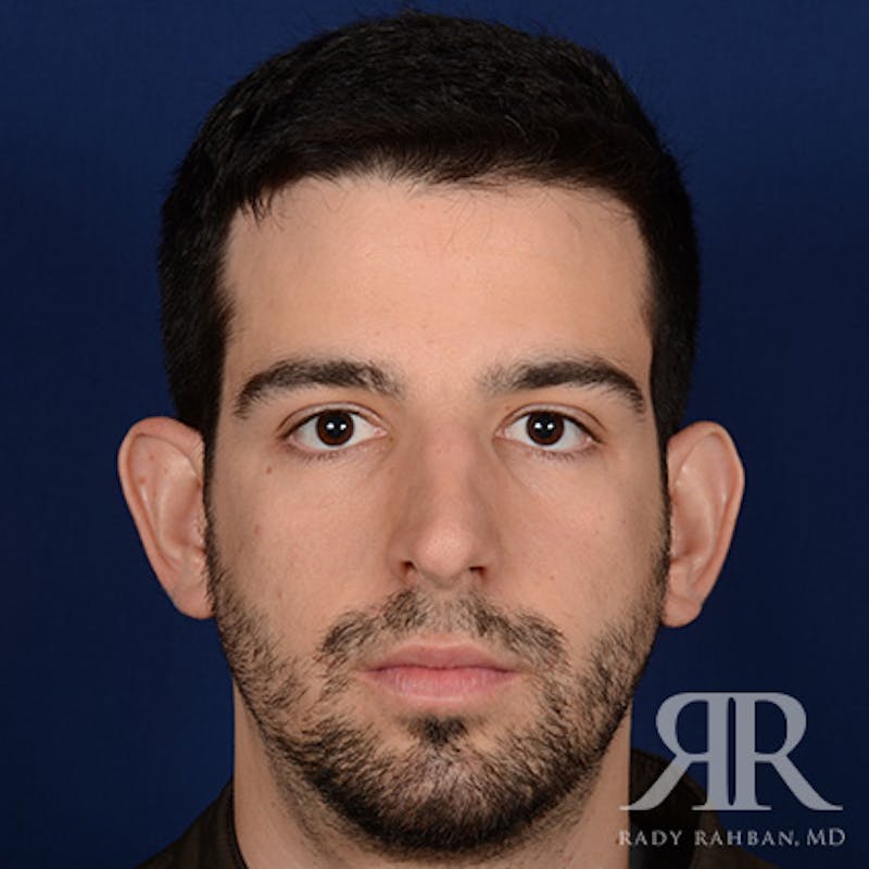 Male Rhinoplasty Before & After Gallery - Patient 360368 - Image 1