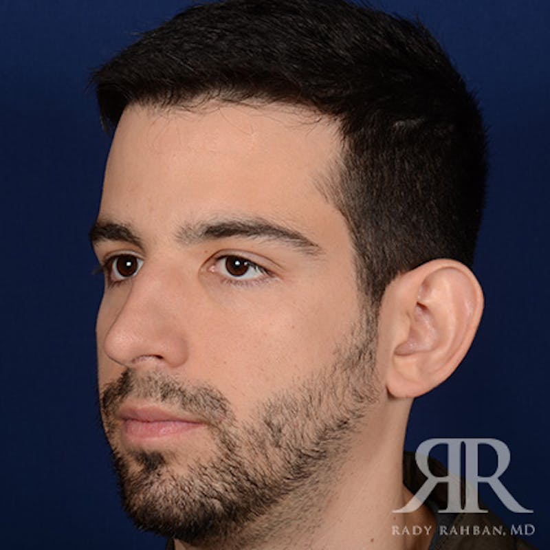 Male Rhinoplasty Before & After Gallery - Patient 360368 - Image 3