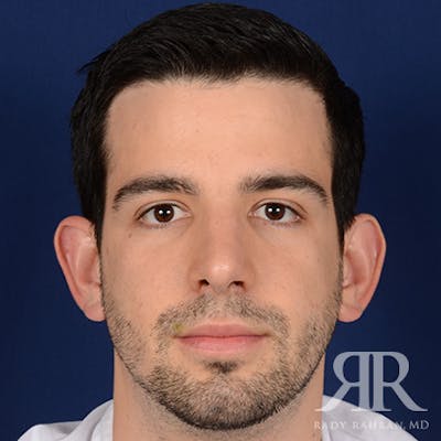 Male Rhinoplasty Before & After Gallery - Patient 360368 - Image 2