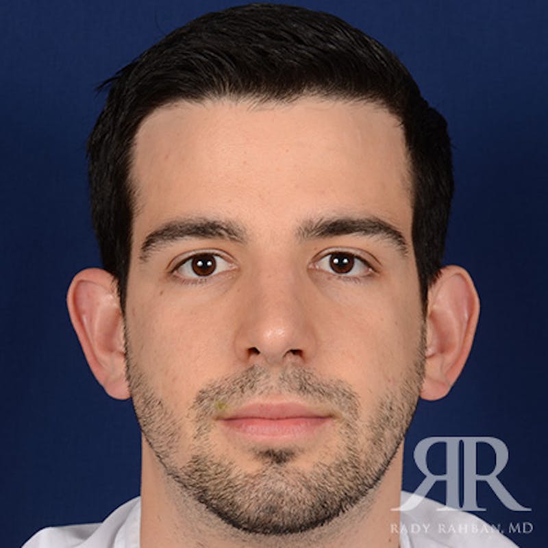 Male Rhinoplasty Before & After Gallery - Patient 360368 - Image 2