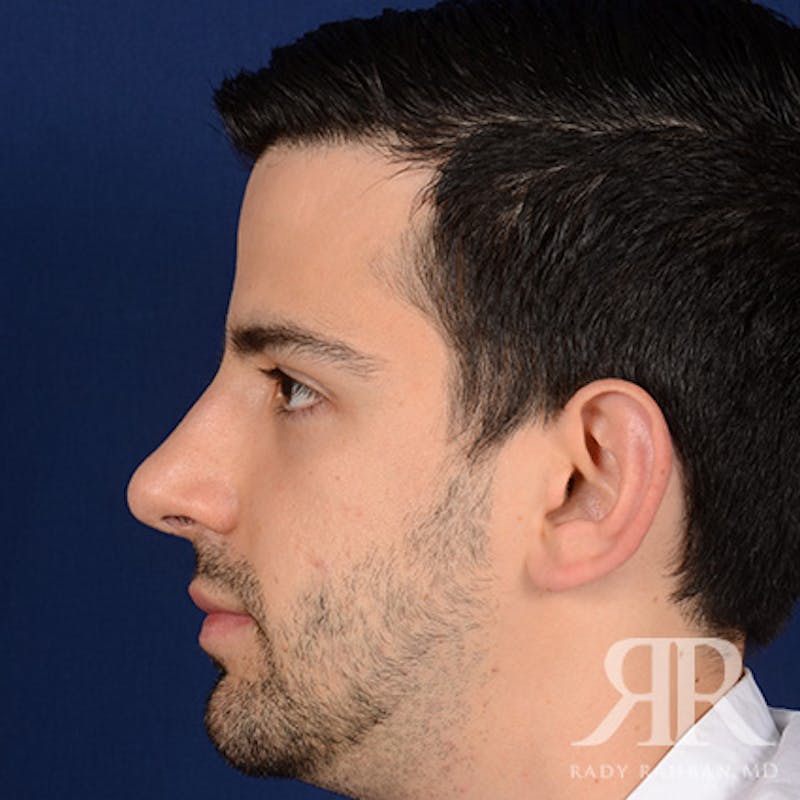 Male Rhinoplasty Before & After Gallery - Patient 360368 - Image 6