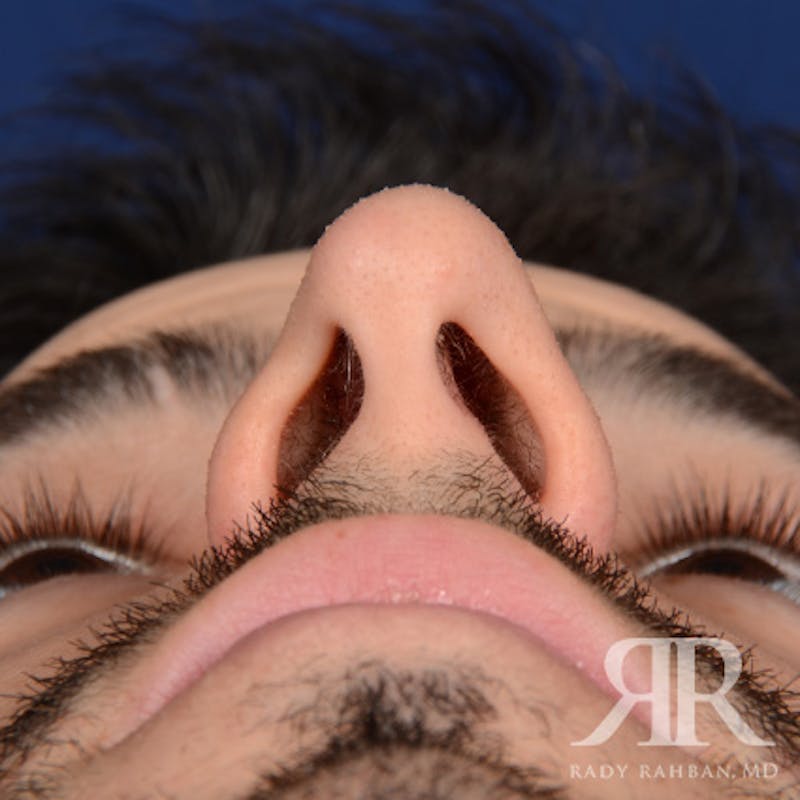 Male Rhinoplasty Before & After Gallery - Patient 360368 - Image 7