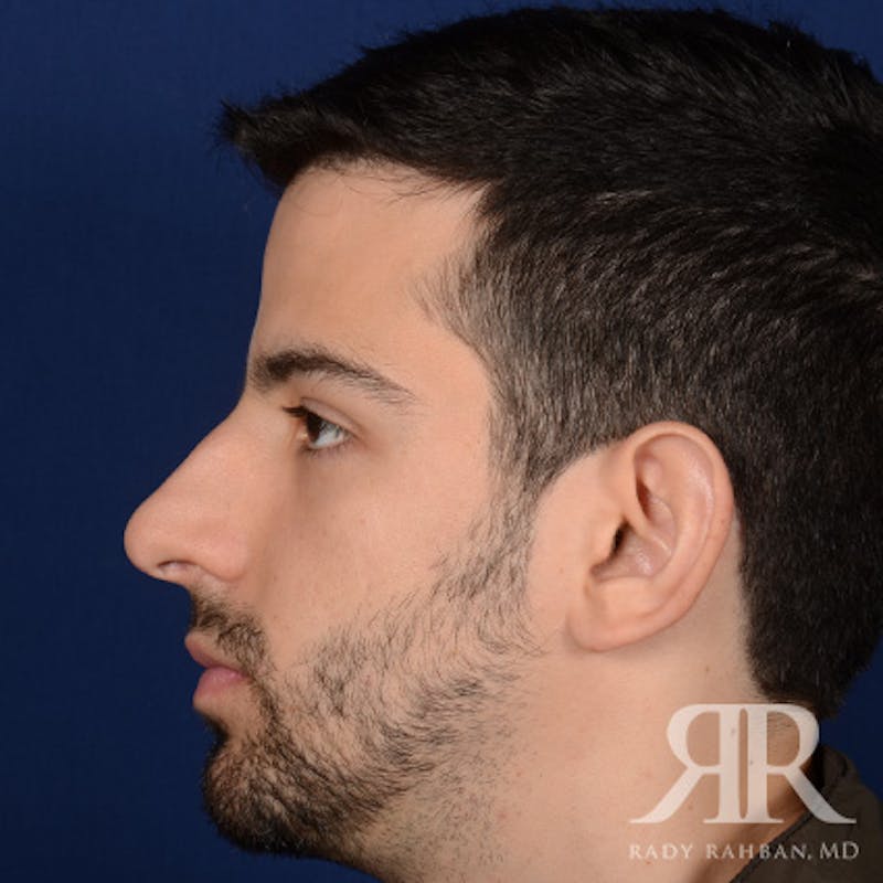 Male Rhinoplasty Before & After Gallery - Patient 360368 - Image 5