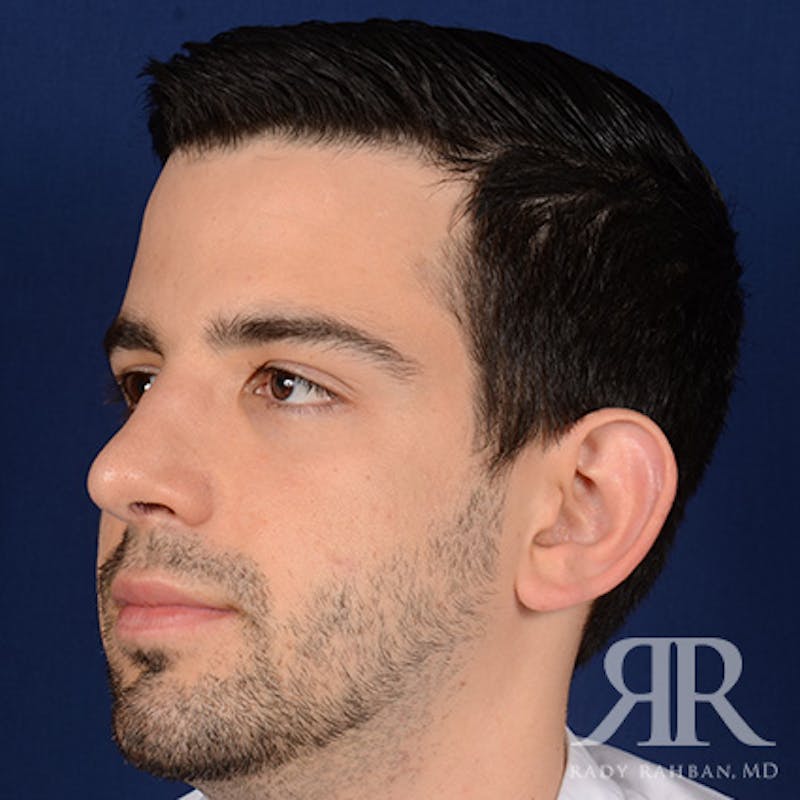Male Rhinoplasty Before & After Gallery - Patient 360368 - Image 4