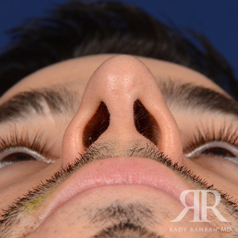 Male Rhinoplasty Before & After Gallery - Patient 360368 - Image 8