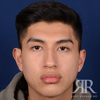 Male Rhinoplasty Before & After Gallery - Patient 304494 - Image 1