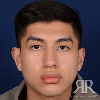 Male Rhinoplasty Before & After Gallery - Patient 304494 - Image 2