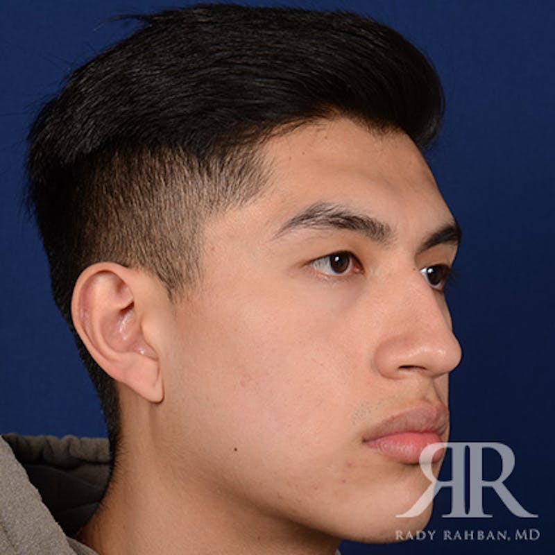 Male Rhinoplasty Before & After Gallery - Patient 304494 - Image 3