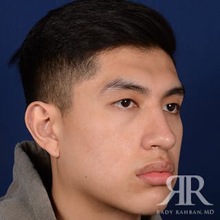 Male Rhinoplasty Before & After Gallery - Patient 304494 - Image 4