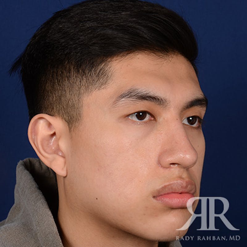 Male Rhinoplasty Before & After Gallery - Patient 304494 - Image 4