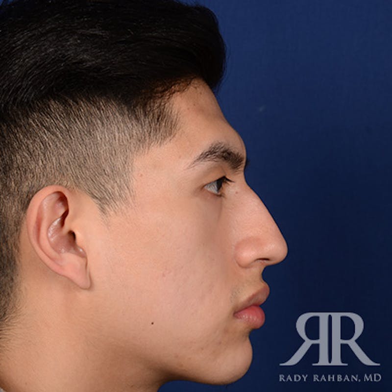 Male Rhinoplasty Before & After Gallery - Patient 304494 - Image 5