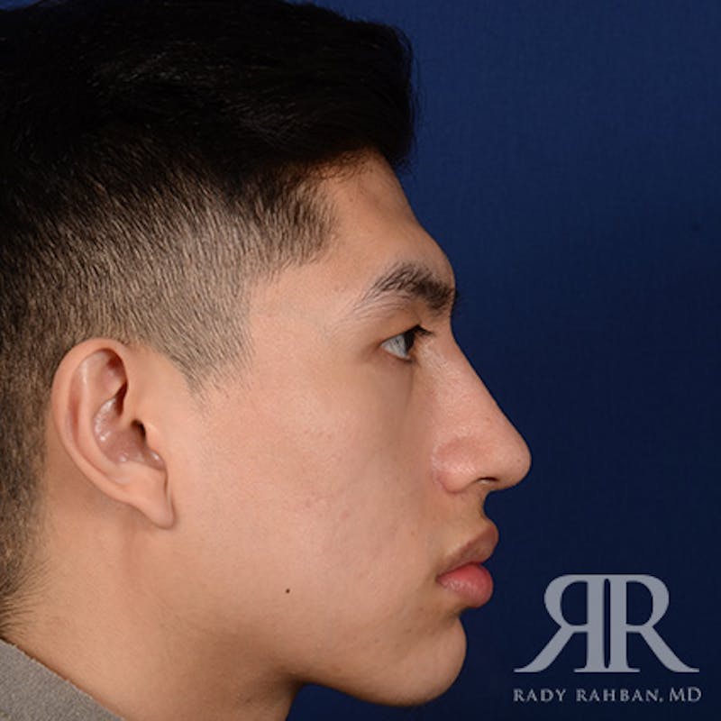 Male Rhinoplasty Before & After Gallery - Patient 304494 - Image 6