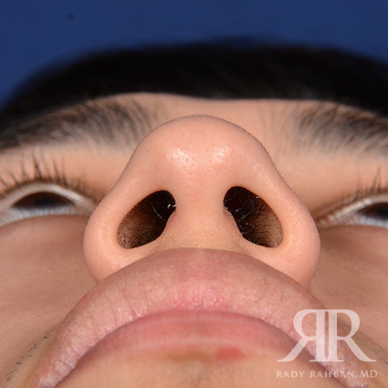 Male Rhinoplasty Before & After Gallery - Patient 304494 - Image 7