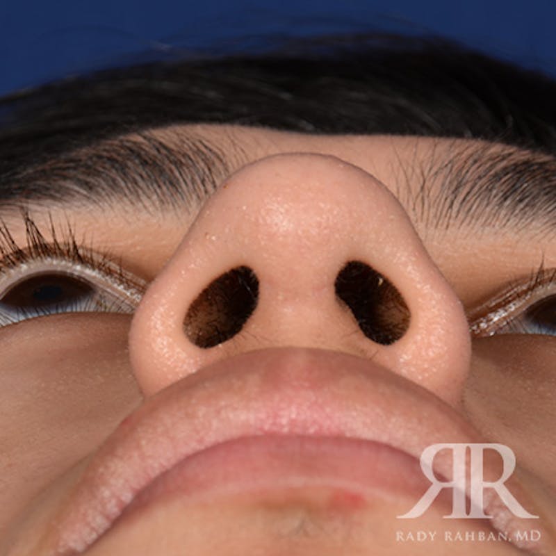 Male Rhinoplasty Before & After Gallery - Patient 304494 - Image 8