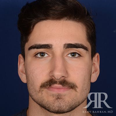 Male Rhinoplasty Before & After Gallery - Patient 103867 - Image 1