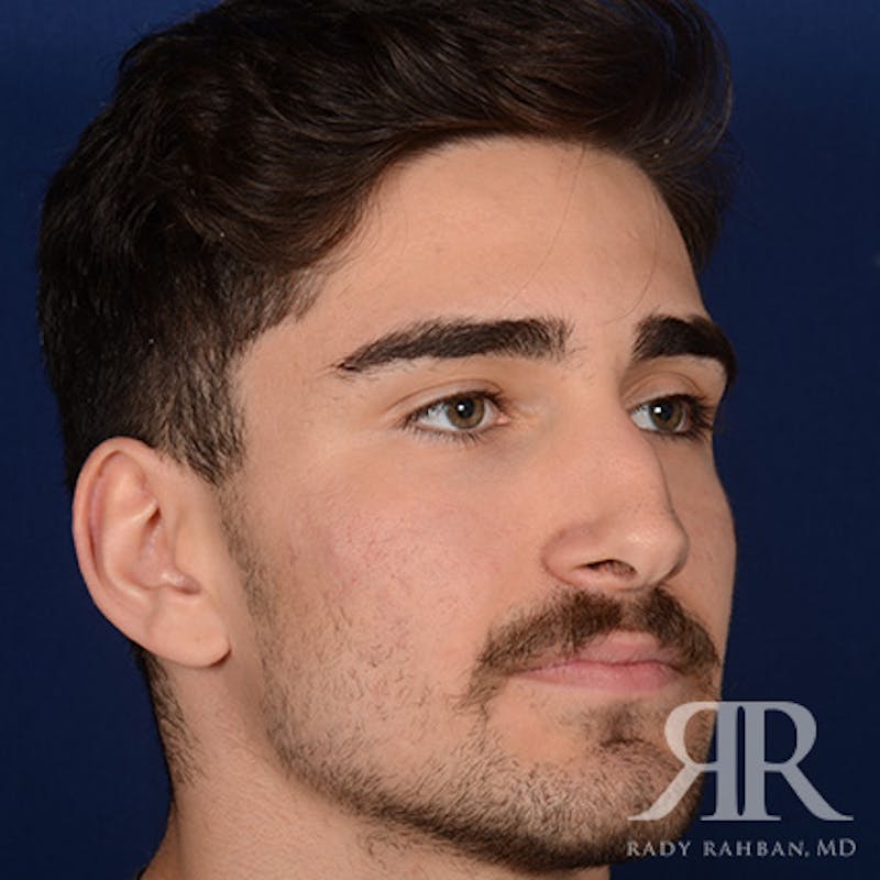 Male Rhinoplasty Before & After Gallery - Patient 103867 - Image 3