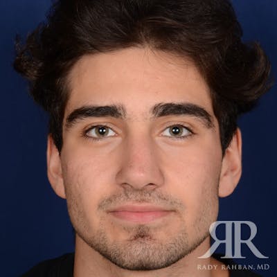 Male Rhinoplasty Before & After Gallery - Patient 103867 - Image 2