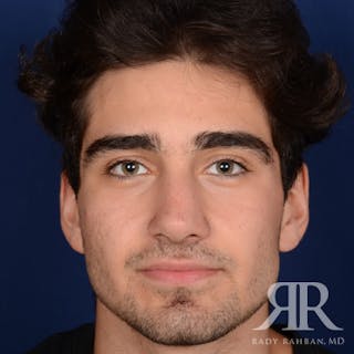 Male Rhinoplasty Before & After Gallery - Patient 103867 - Image 2