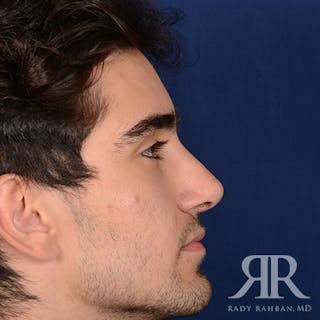 Male Rhinoplasty Before & After Gallery - Patient 103867 - Image 6